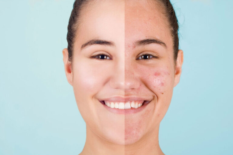 before and after result of acne treatment at rysa the Best Skin Care Treatments in Trivandrum